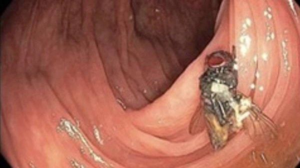 Médicos descobrem mosca viva e intacta dentro do intestino de idoso
