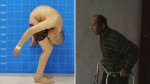 Medicina: ‘Homem dobrado’ volta a ficar de pé após 28 anos curvado